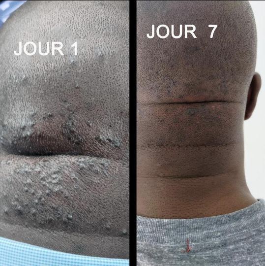 Crème naturel hydratante Stopper Chéloïde bosses de rasoir bouton de nuque cicatrices / Natural Bump Stopper Cream neck pimple cream
