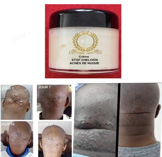 Crème naturel hydratante Stopper Chéloïde bosses de rasoir bouton de nuque cicatrices / Natural Bump Stopper Cream neck pimple cream