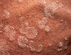 NAOMI CRÈMECrème ANTI FONGIQUE -ANTIBACTERIEN ANTI INFLAMATOIRE SOIGNE EN PROFONDEUR LES IMPERFECTIONS TRIPLE ACTIONS