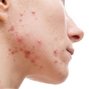 NAOMI CRÈMECrème ANTI FONGIQUE -ANTIBACTERIEN ANTI INFLAMATOIRE SOIGNE EN PROFONDEUR LES IMPERFECTIONS TRIPLE ACTIONS
