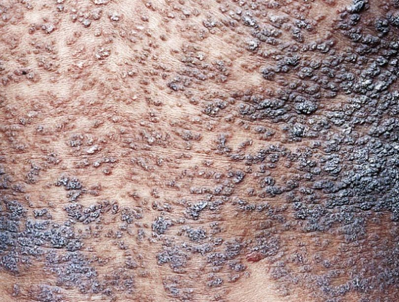 NAOMI CRÈMECrème ANTI FONGIQUE -ANTIBACTERIEN ANTI INFLAMATOIRE SOIGNE EN PROFONDEUR LES IMPERFECTIONS TRIPLE ACTIONS
